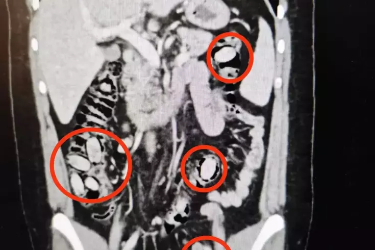 Eskişehir'de polisin durdurduğu şahsın midesinden çıkanlar şoke etti