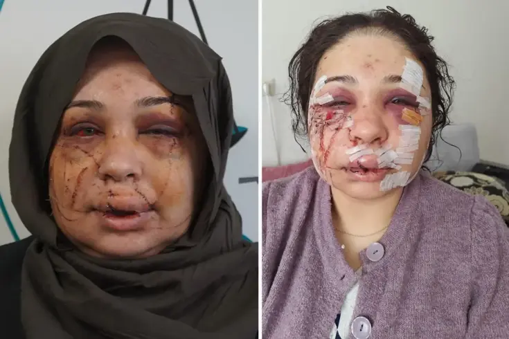 Polis eşi tarafından darbedildiği iddiasıyla şikayetçi oldu