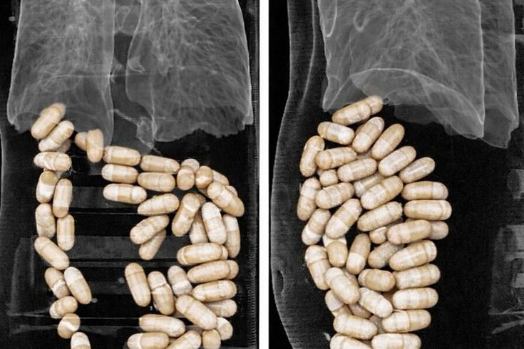 İzmir'de 2 şüphelinin midesinden 1 kilo 304 gram uyuşturucu çıktı
