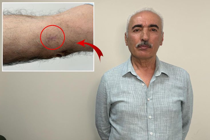 Kolundaki 1 santimetrelik yara kanser çıktı
