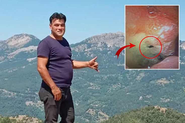 Kabus gibi olay! Midesinden canlı böcek çıkarıldı