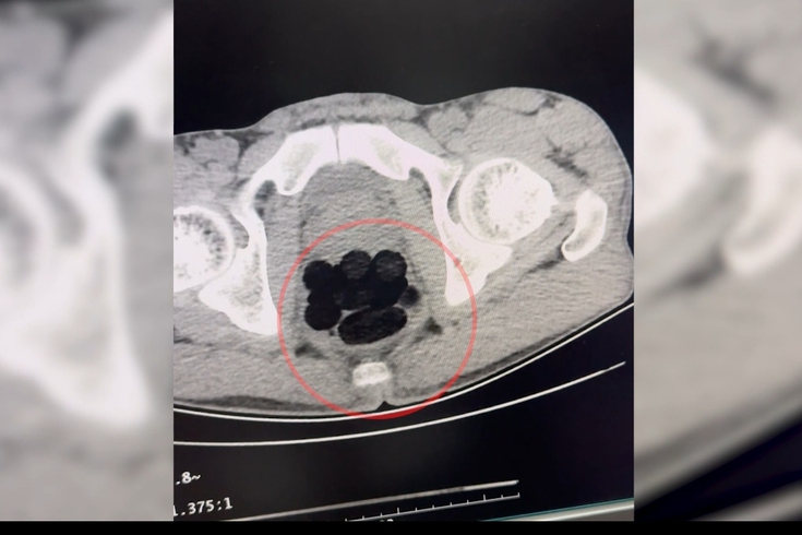 Batman'da otobüste yakalandı! Midesinden 35 parça halinde 253 gram eroin çıktı