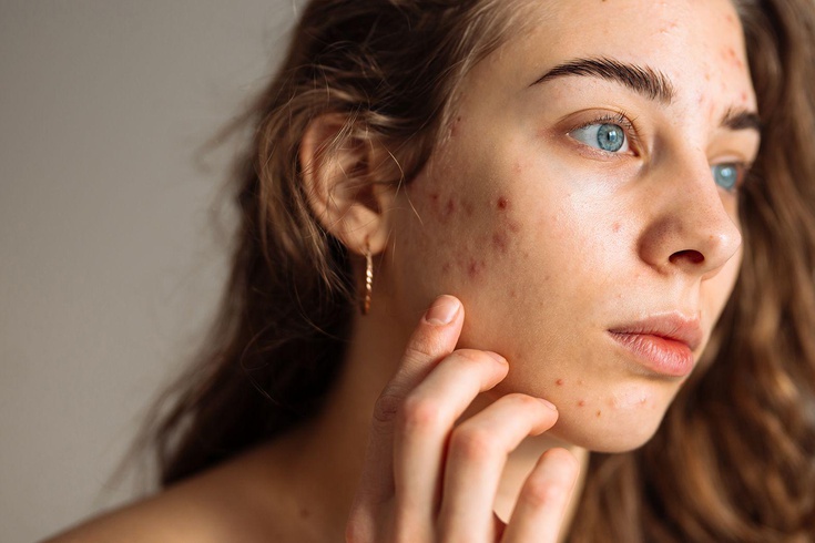 Ergenlerde cam gibi cilt takıntısı büyüyor! Uzmanlar uyardı: Serum ve asit yığmak cildi bozuyor, 3 ürün yeterli