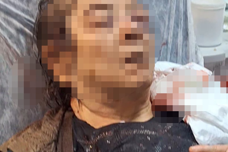 Kayseri'de evinde otururken tavan sıvası üzerine çöktü! 75 yaşındaki kadının sol gözünde ciddi görme kaybı