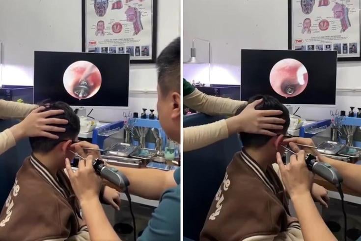 Küçük çocuğun kulağından çıkana, doktorlar bile şaştı kaldı