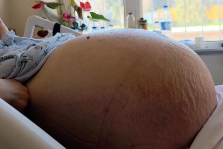 Doktorları bile şaşırtan vaka! Kabızlık sandı ama karnı burnuna geldi