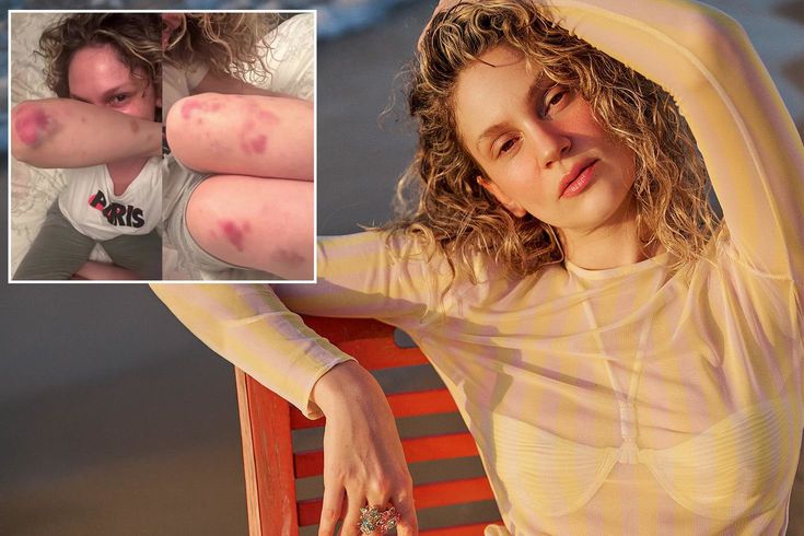 Farah Zeynep Abdullah'ın vücudundaki morluklar korkuttu