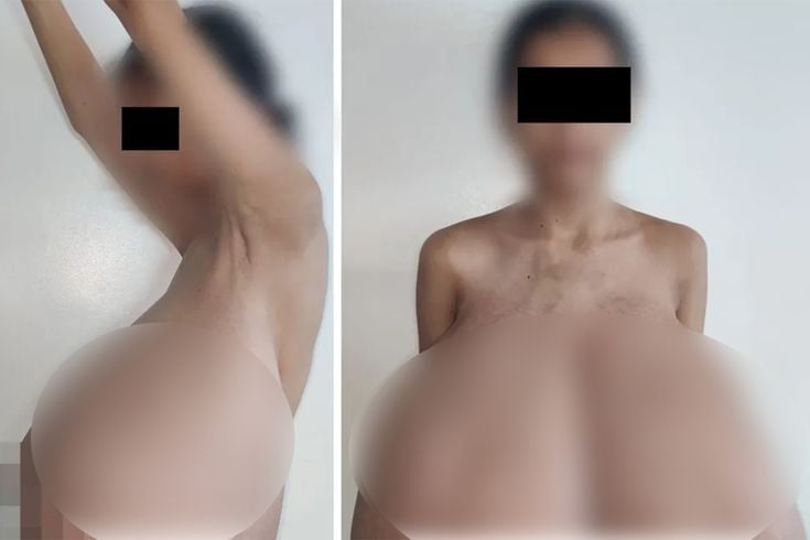 13 yaşında başladı! Göğüsleri vücut ağırlığının dörtte birine ulaştı