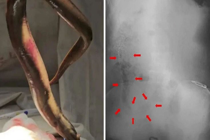 Avlanırken makatından vücuduna yılan balığı girdi! Ameliyatta canlı çıkarıldı