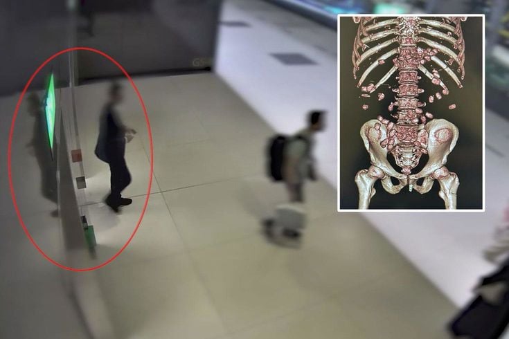 İran uyruklu şüphelinin midesinden 380 gram metamfetamin çıktı
