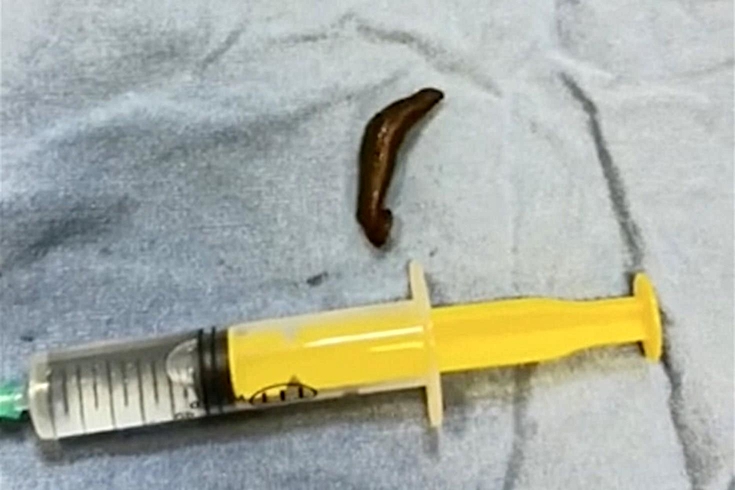 Çorum'da çeşmeden su içti, boğazından canlı sülük çıktı! Doktoru: İlk defa gördüm