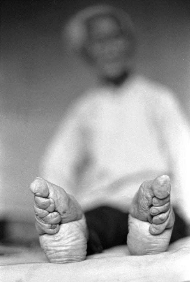 Chinese footbinding the history of a curious erotic custom