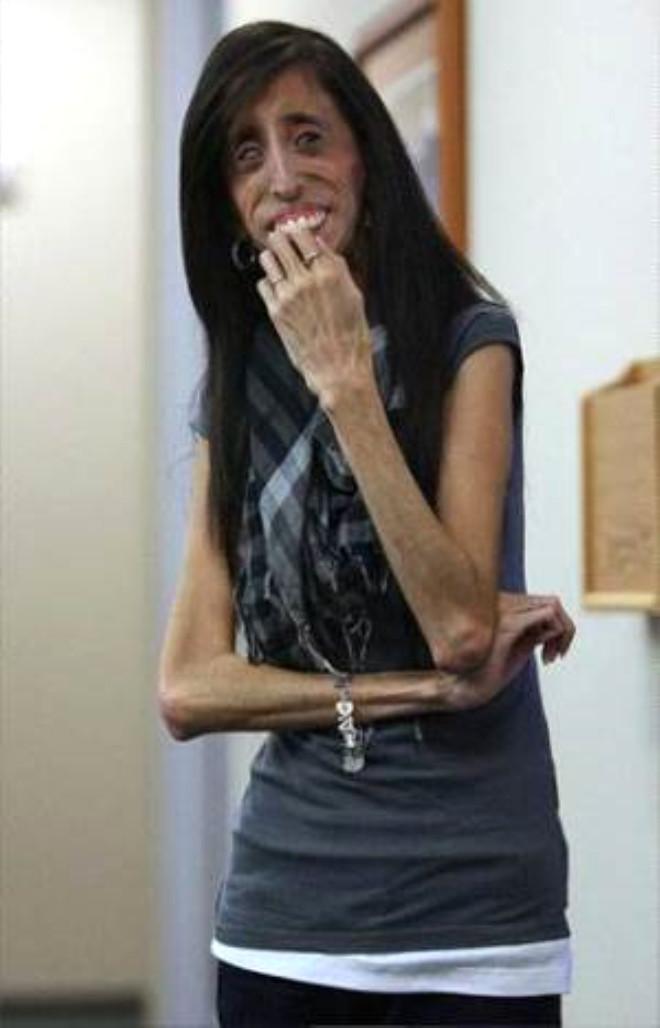 23 yasinda ama sadece 27 kilo foto