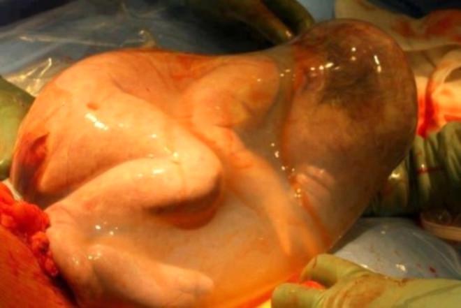 bebek kesenin icinde dogdu foto galerisi