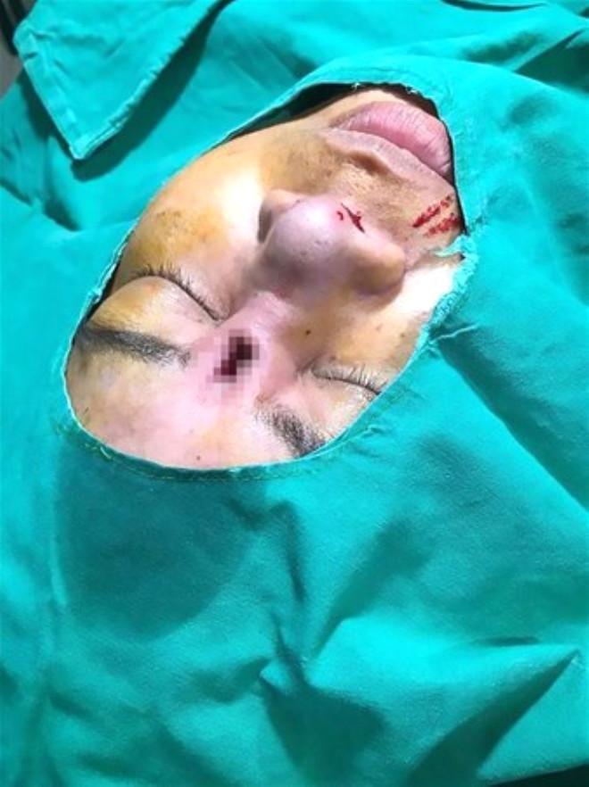 Ucuz Burun Estetiği Faciaya Sebep Oldu
