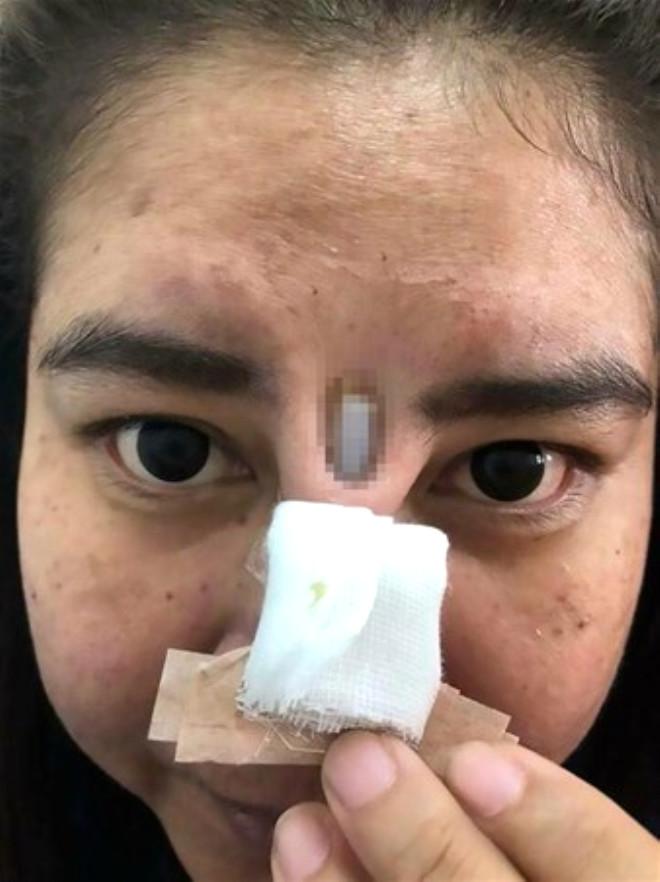 Ucuz Burun Estetiği Faciaya Sebep Oldu