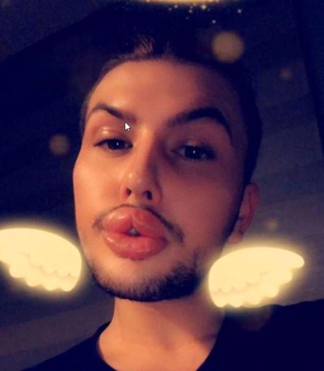 Estetik Bağımlılığı Yüzünden Dudakları Patlama Noktasına Geldi