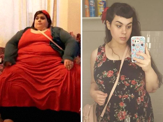 Obezite Hastası Kadın, Erkek Arkadaşıyla Aynı Yatağa Girmek İçin 192 Kilo Verdi!