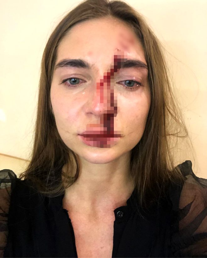 Dudaklarına silikon yaptırmak isteyen Rus şarkıcı, doktorunun saldırısına uğradı!