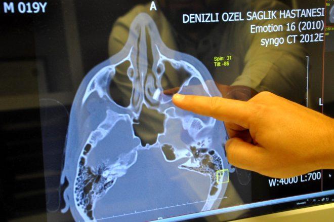 Nefes alamıyor diye soluğu hastanede aldı! Burnundan çıkan şey doktorları bile şoke etti