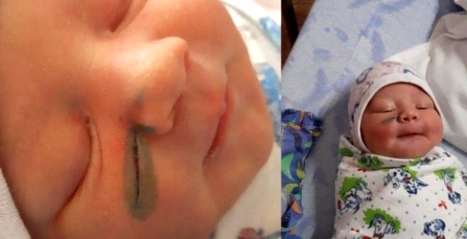 Akılalmaz hata! Doktorlar doğum sırasında bebeğin yüzünü kesti