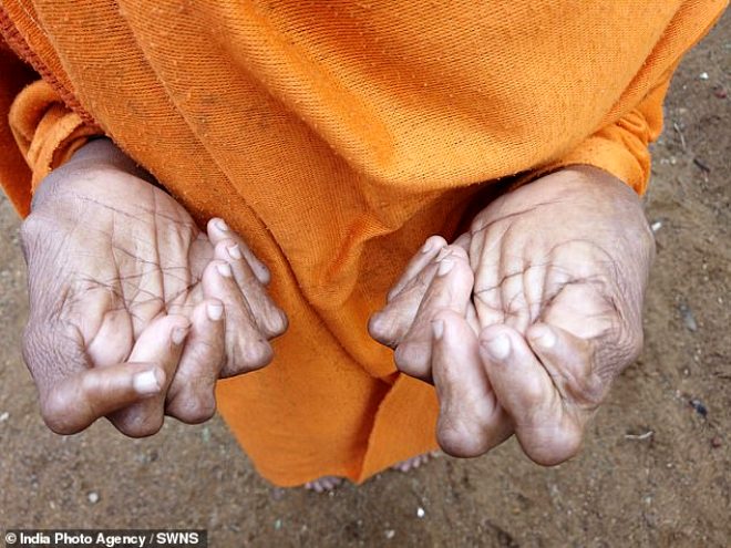 31 parmaklı olan 63 yaşındaki kadın