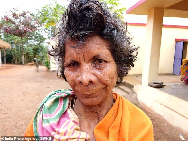 31 parmaklı olan 63 yaşındaki kadın