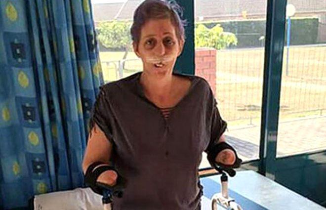 Firavun faresi tarafından ısırılan kadın, uzuvlarını kaybetti