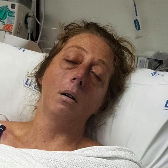 Firavun faresi tarafından ısırılan kadın, uzuvlarını kaybetti