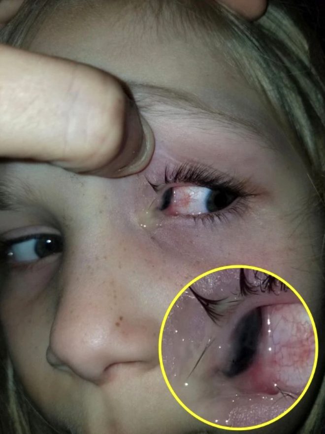Acı içerisinde uyanan 6 yaşındaki kızın gözünden bezelye tanesi büyüklüğünde böcek çıktı