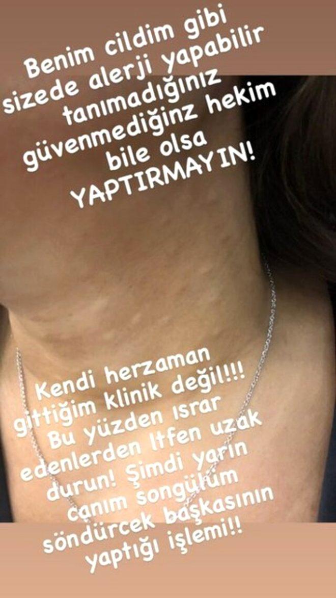 Güzelleşeyim derken sağlığından oldu! Estetik mağduru Akalın'ın boynu herkesi korkuttu