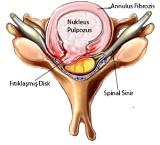 Bel fıtığı hastalarının %99 unun ameliyatsız kurtulması mümkün