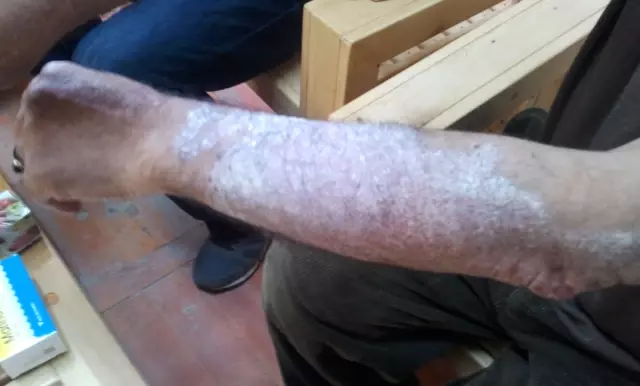 Hisarcık Esire Kaplıcaları'nda Sedef Hastalığı Tedavisinde Olumlu Gelişme