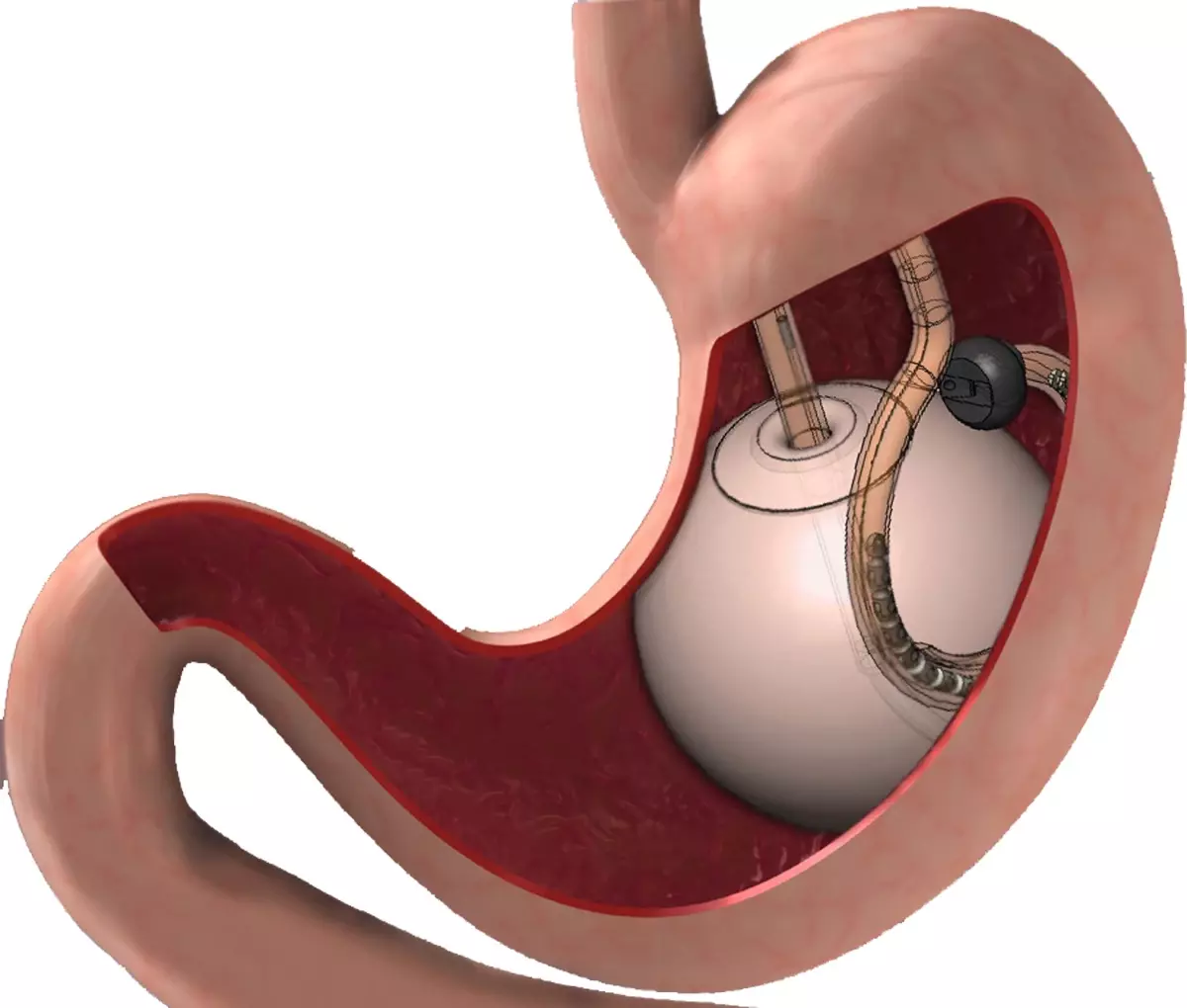 Похудеть с баллоном в желудке быстро