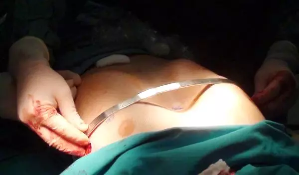Göğüs Kafesi Çelik Barla Düzeltildi Göğüs Kafesi Çelik Barla Düzeltildi