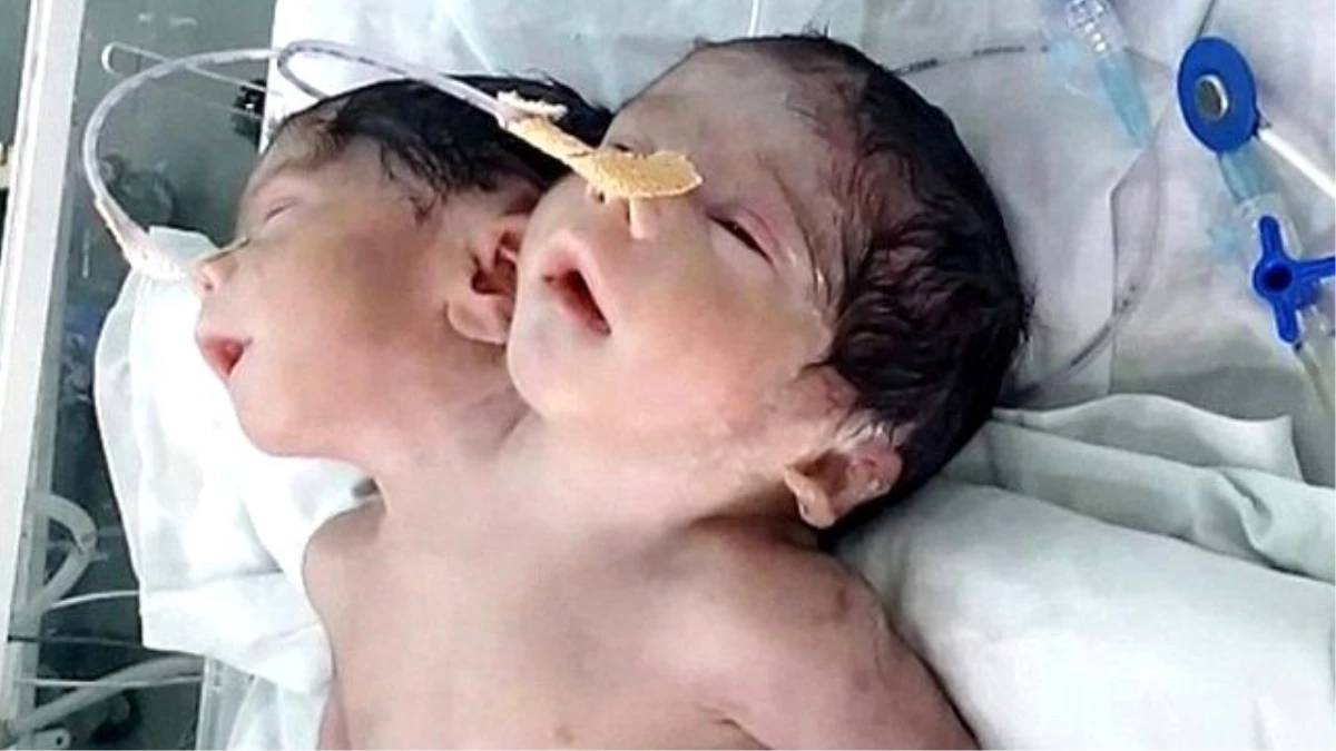 İki Başlı Bebek, Doğumundan 32 Saat Sonra Hayata Gözlerini Yumdu - Haberler