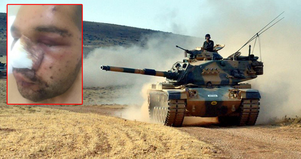 El Bab'da Yaralanan Uzman Onbaşı: Bir Gözü Kaybettiysek Diğeri Bize Yeter