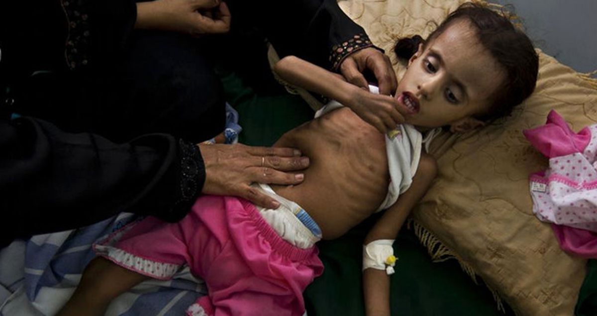 BM: Her 10 Dakikada Bir, Yemen'de Bir Çocuk Açlıktan veya Hastalıktan Ölüyor