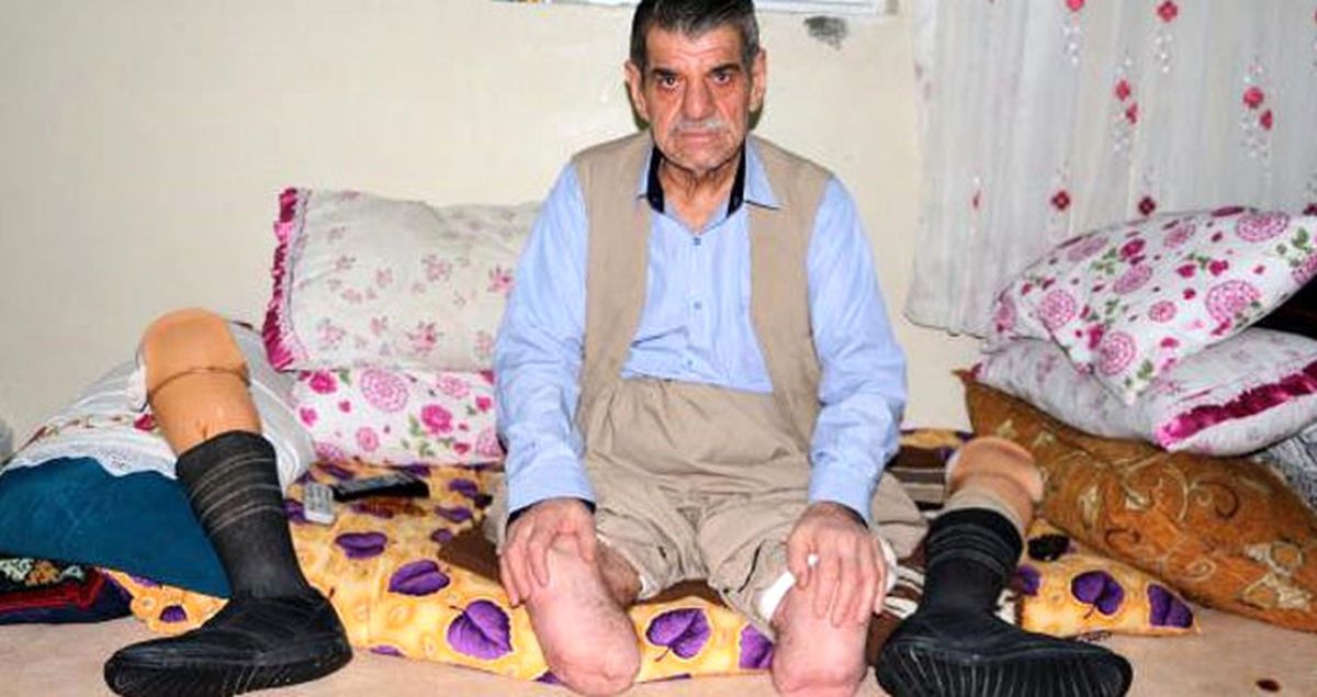 Sigara Yüzünden 2 Bacağını Kaybeden Ahmet Şan'dan Uyarı