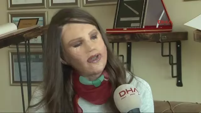 Türk Doktorun Yüzü Yanan Hastanın Dokusundan Geliştirdiği Tedavi Tıp Literatürüne Girdi Türk Doktorun Yüzü Yanan Hastanın Dokusundan Geliştirdiği Tedavi Tıp Literatürüne Girdi