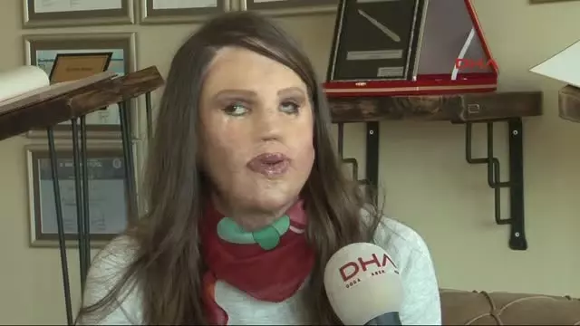 Türk Doktorun Yüzü Yanan Hastanın Dokusundan Geliştirdiği Tedavi Tıp Literatürüne Girdi Türk Doktorun Yüzü Yanan Hastanın Dokusundan Geliştirdiği Tedavi Tıp Literatürüne Girdi