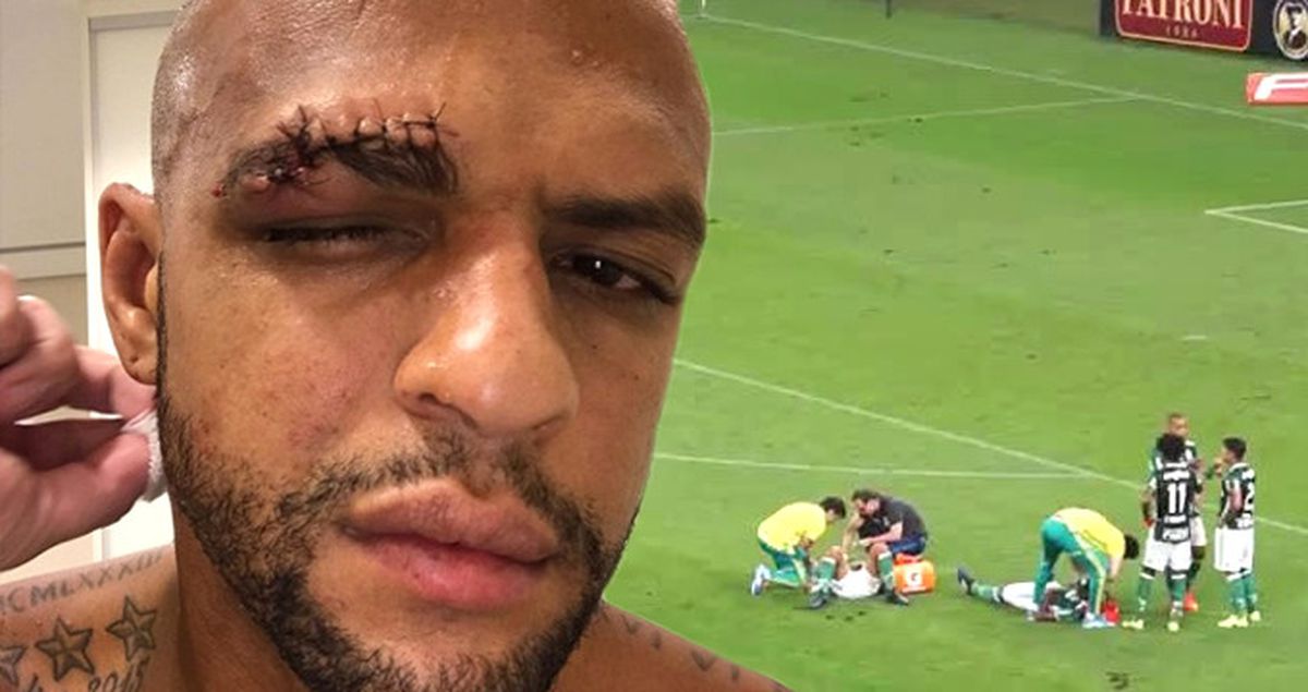 Eski Galatasaraylı Felipe Melo'nun Maçta Kaşı Patladı