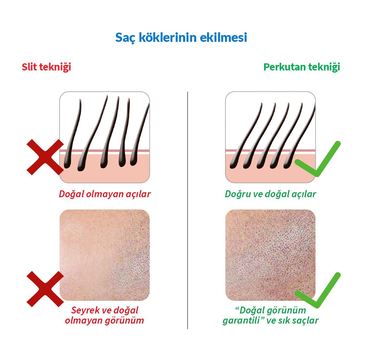 Saç Ekiminde Perkutan Dönemi