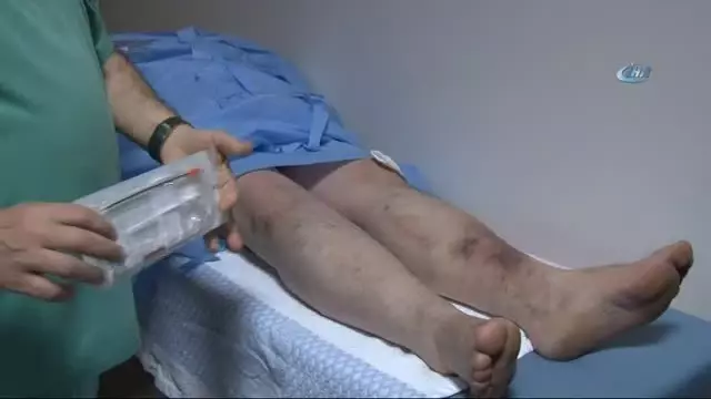 Varis Tedavisinde Radyofrekans Dönemi Varis Tedavisinde Radyofrekans Dönemi