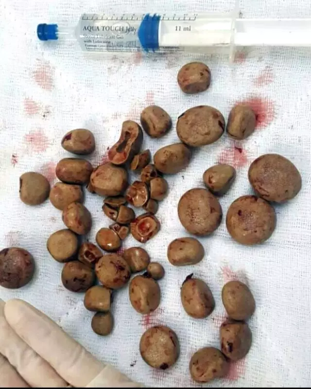 İdrar Torbasından 300 Gram Ağırlığında 40'ın Üzerinde Taş Çıkartıldı