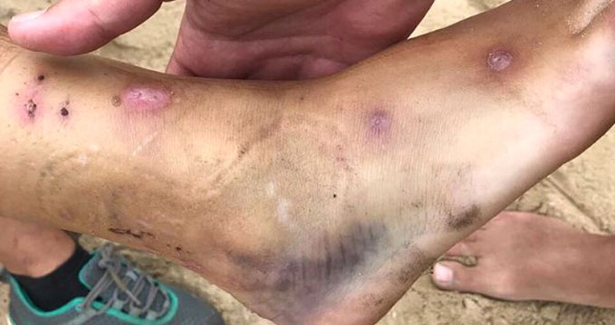 Acun Ilıcalı, Survivor'da Sakatlanan Sema'nın Ayağının Son Halini Paylaştı