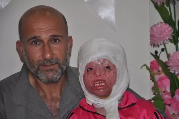 Suriyeli Minik Ayşe'nin Sağlığına Kavuşmak İstiyor