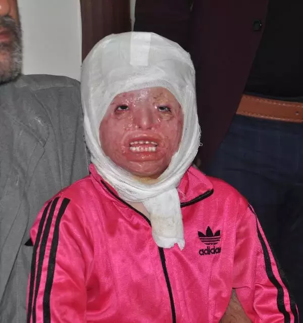 Suriyeli Minik Ayşe'nin Sağlığına Kavuşmak İstiyor