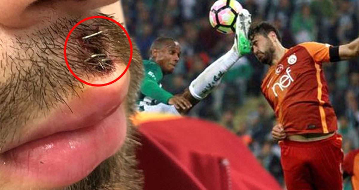 Galatasaraylı Ahmet Çalık'ın Dudağına, Faty'nin Tekmesinden Sonra Dikiş Atıldı