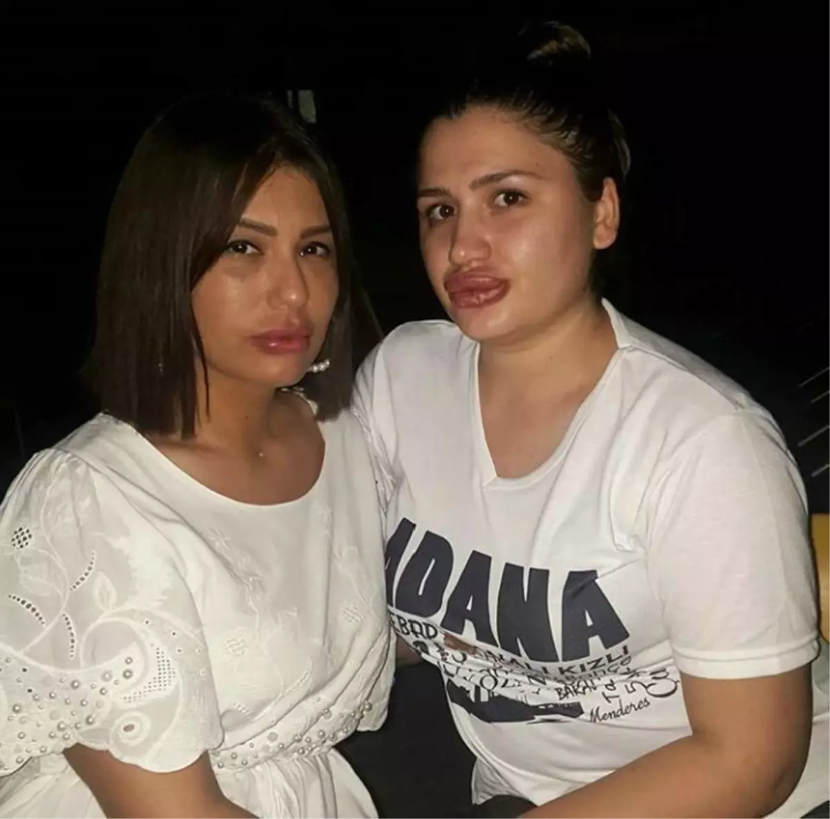Estetik Dolgu Magdurlari Sikayetci Oldu Adana